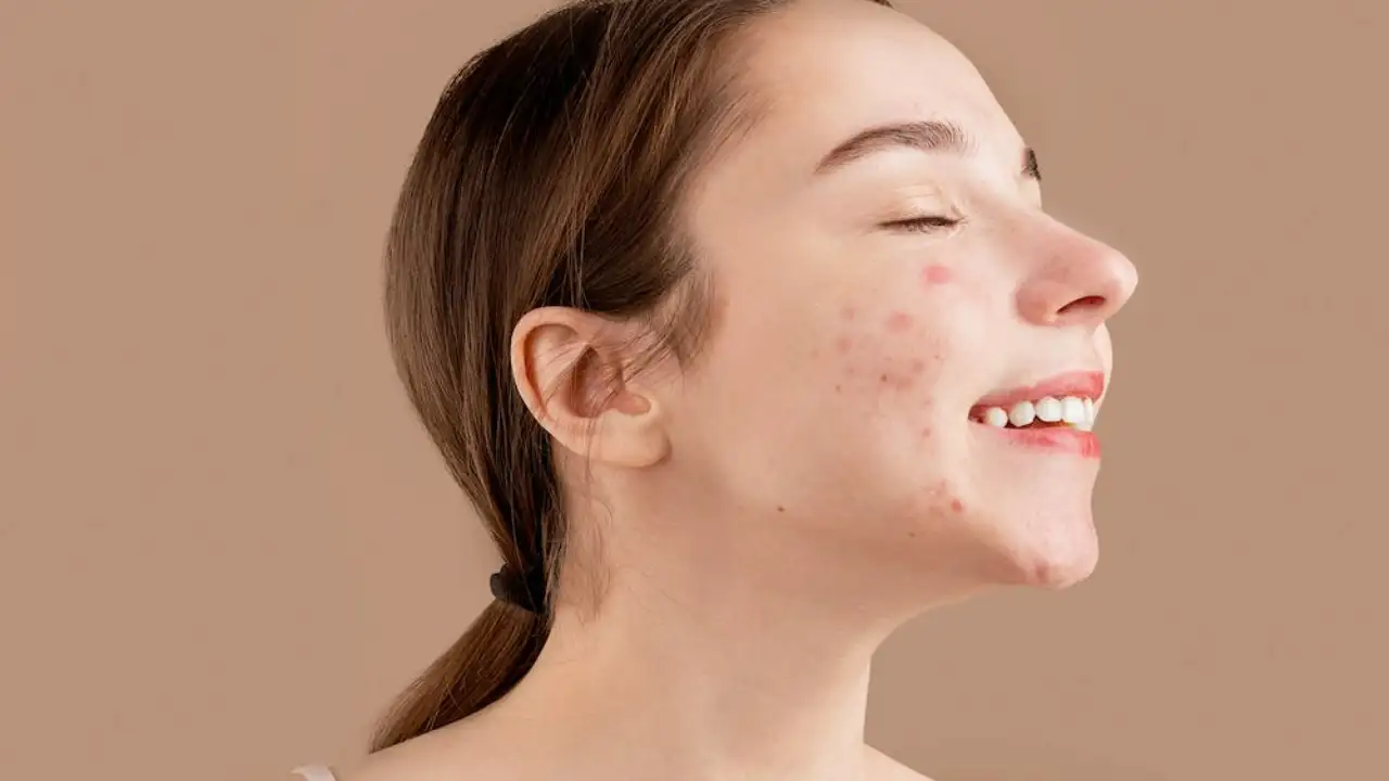 A woman banishing her acne Pexels