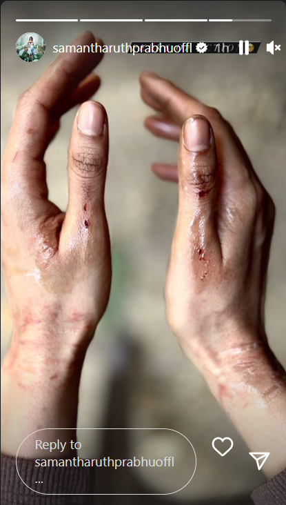 Samantha Ruth Prabhu shared a pic of her wounded hands from sets of Citadel.