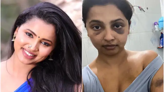 Malayalam actor Anicka Vikhraman shares pics of bruises, reveals shocking details of her abusive relationship | PINKVILLA