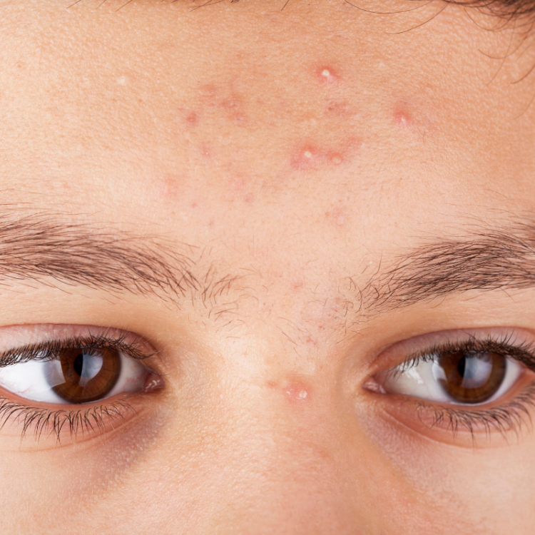 5 Causes of white spots on the skin and how to prevent them