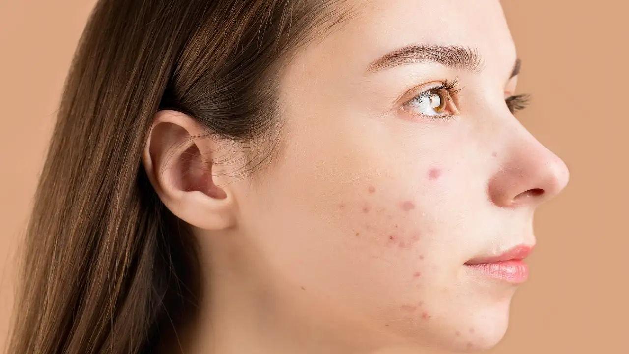 How vitamin E can impact acne and skin health?