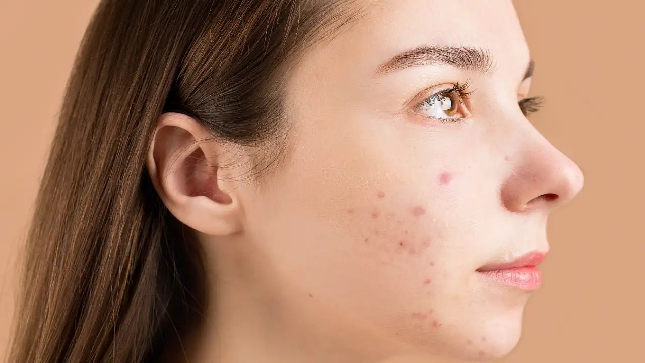 How vitamin E can impact acne and skin health? PINKVILLA