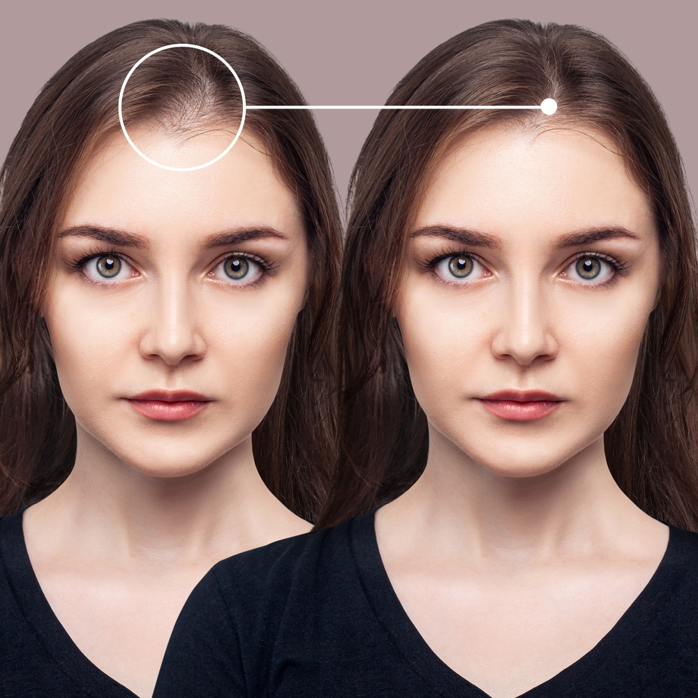 Receding Hairline Women Temples what-to-wear-to-the-masters-golf-outfits-women-golf-tournament