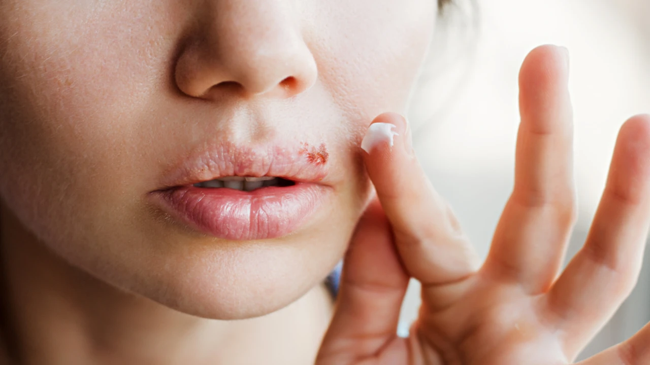 Cold Sore Vs. Pimple: Key Differences, Treatment And Prevention 