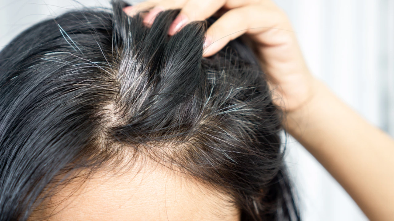 A Haircare Guide for Poliosis: Causes, Symptoms, And Treatments