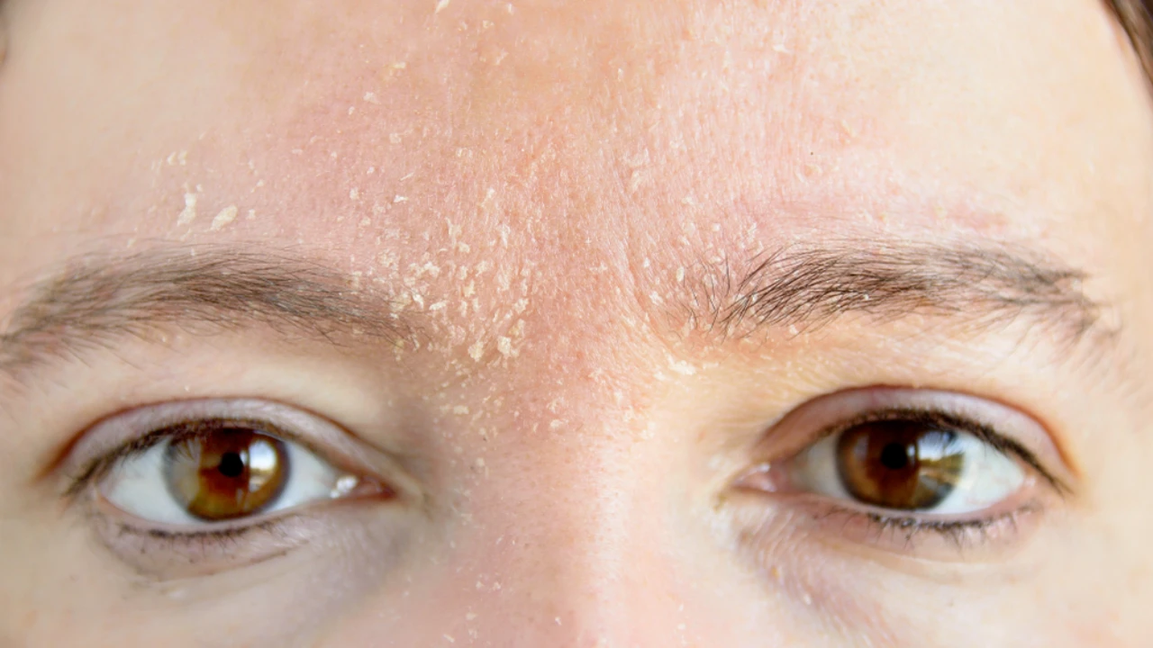 Facial Dandruff Demystified: Causes, Symptoms, And Treatment