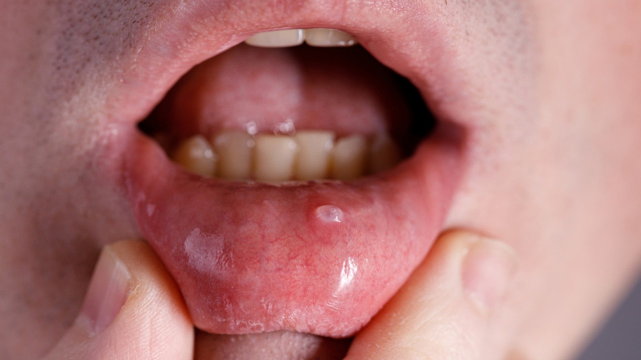 Home Remedies to Treat Mucocele in a Quick And Natural Way