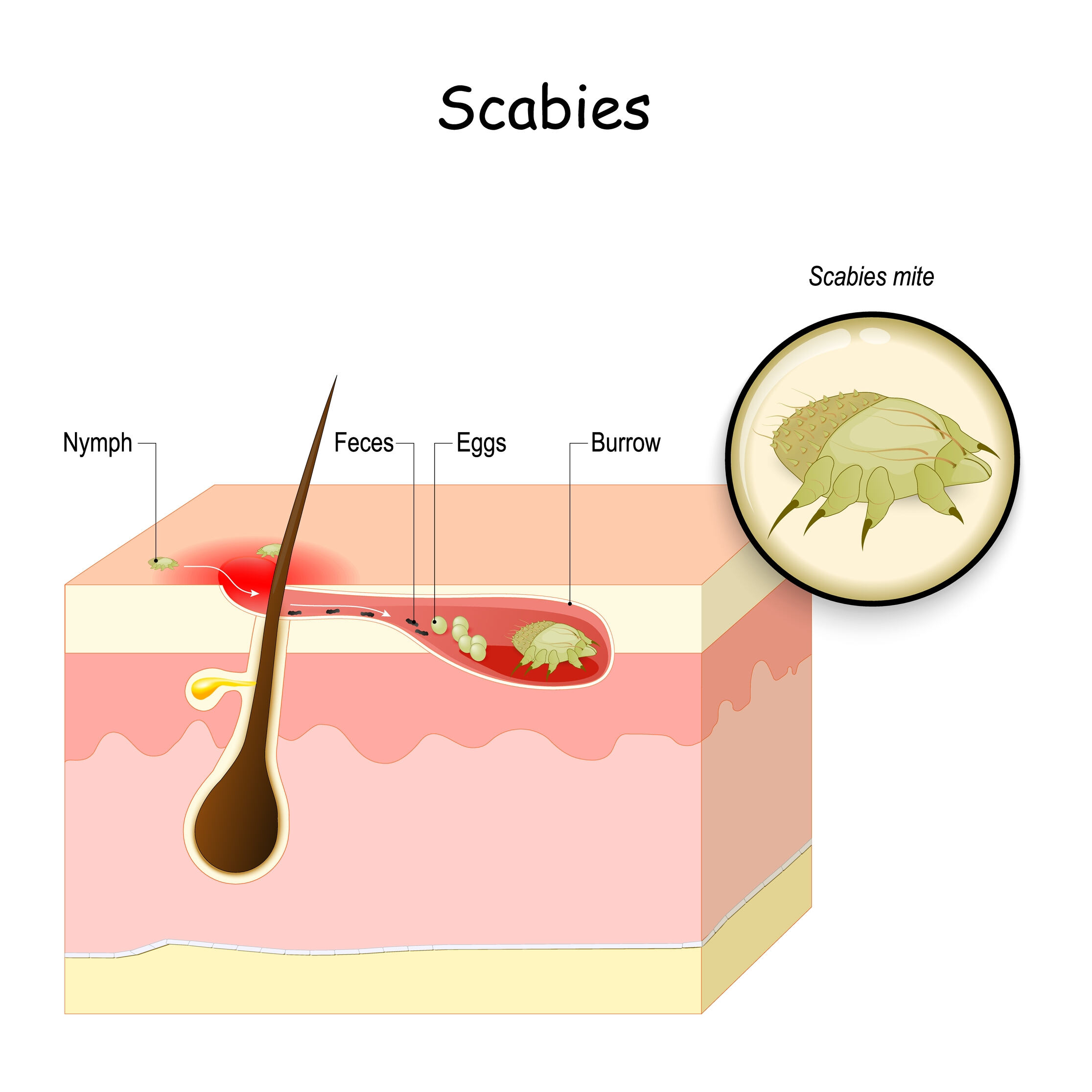 home remedies for scabies home remedies for scabies
