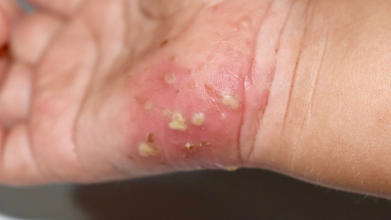Home Remedies for Scabies to Naturally Combat the Infection