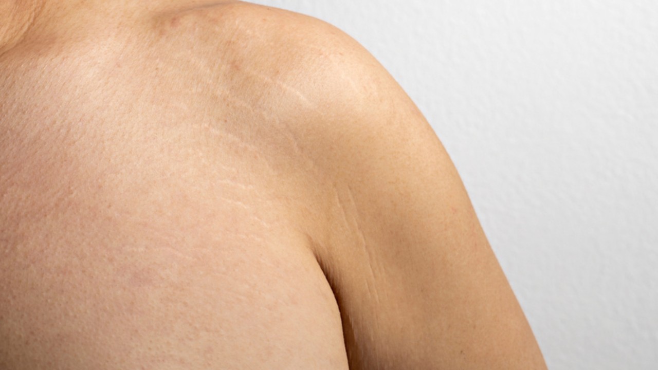 Stretch Marks on the Shoulders: Causes And Solutions Revealed