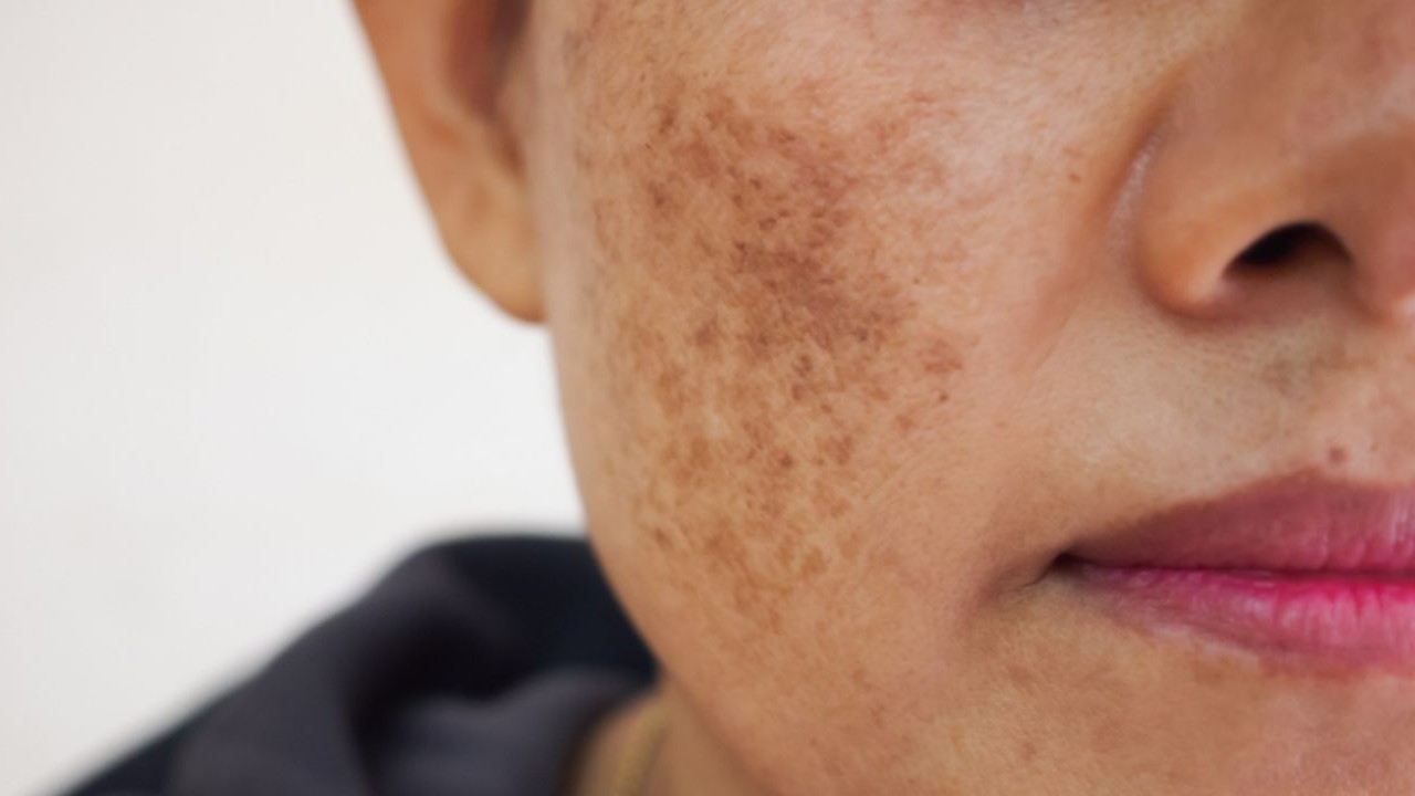 Melasma: A Pervasive Challenge in India's Dermatological Landscape