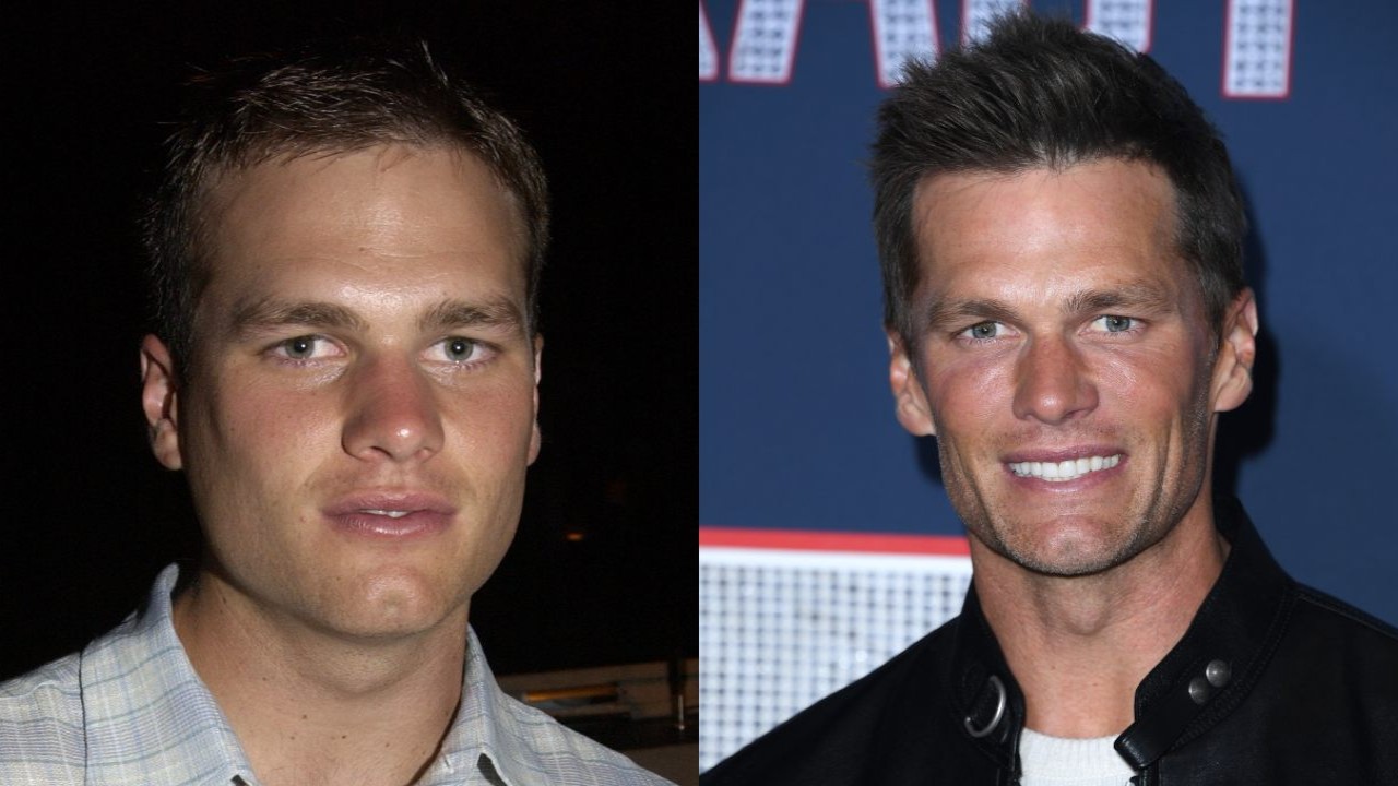 Fact Check: Did Tom Brady Get a Hair Transplant? Exploring Truth Behind QB’s Amazing Transformation From Baldness