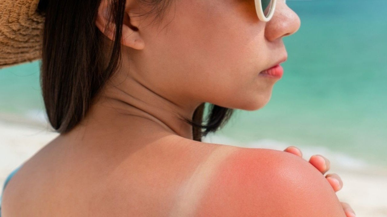 How Long Does Sunburn Last? Understanding Duration, Symptoms, And Treatment