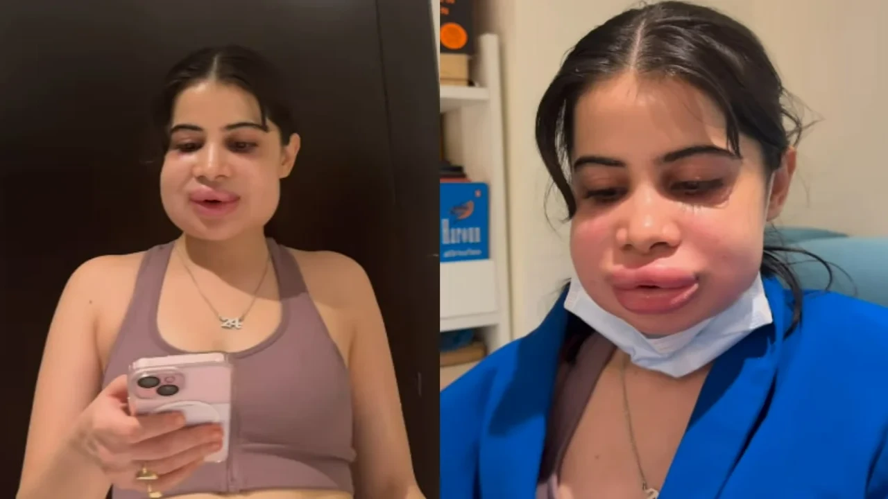 Uorfi Javed drops new VIDEO after her lip filler dissolving procedure (Pic Credit: Uorfi Javed Instagram) Uorfi Javed