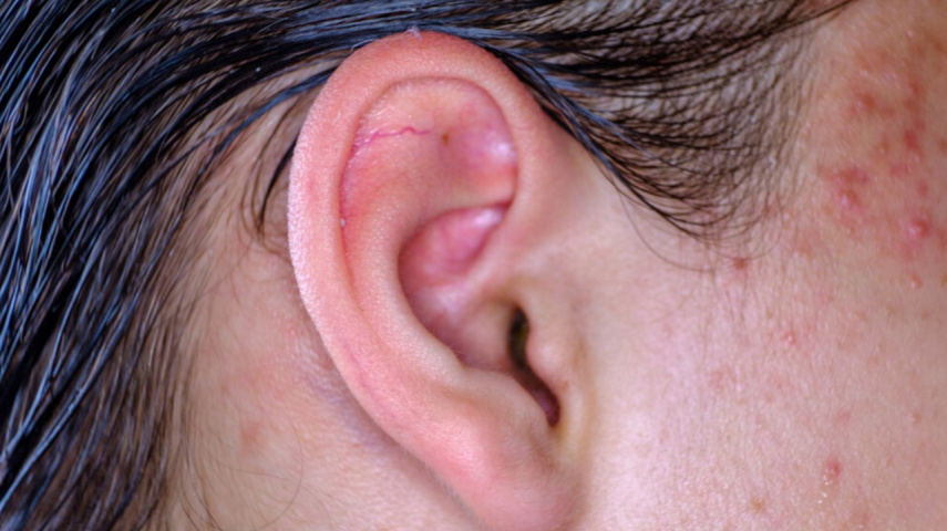 Pimple in ear