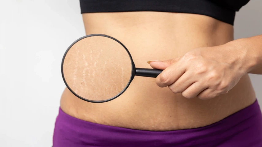 How to Hide Stretch Marks