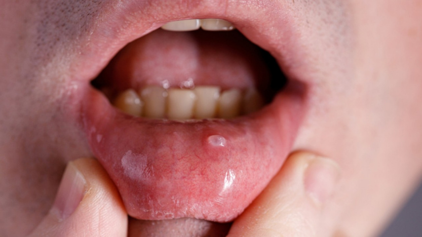 home remedies to treat mucocele