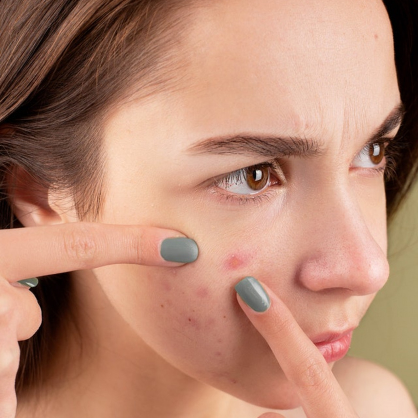 EXCLUSIVE: Skincare tips for teenagers to control acne issues according to Shahnaz Husain