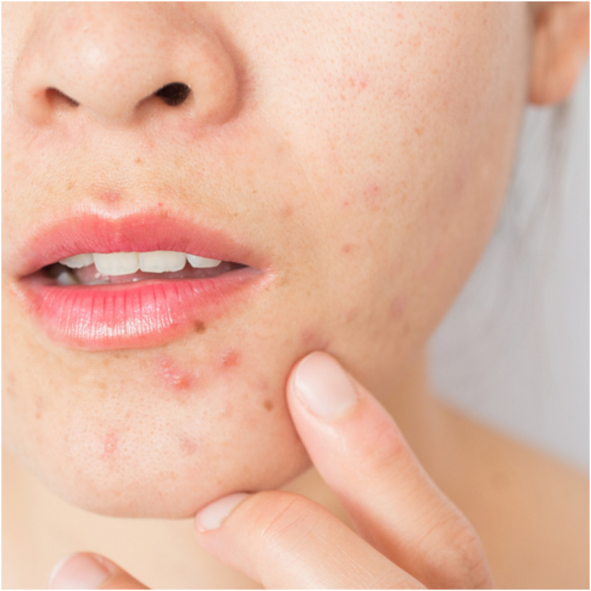 Skin Care Tips: Dermatologist REVEALS whether acne can be cured